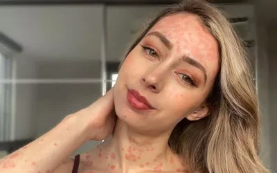 پسوریازیس و روش های درمان آن