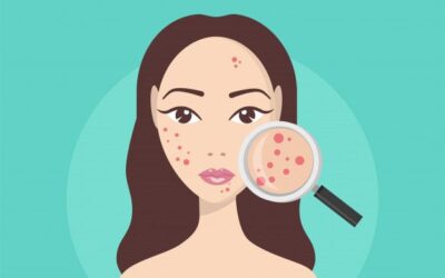 جوش هورمونی و روش های درمان آن