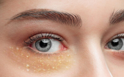 میلیا دور چشم و روش های درمان