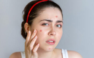 درمان فوری جوش صورت