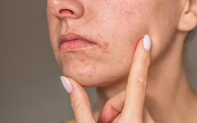 دلایل تشدید اگزمای پوستی در فصل زمستان و درمان آن